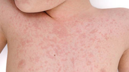 Attention à la recrudescence de cas de rougeole Attention à la recrudescence de cas de rougeole